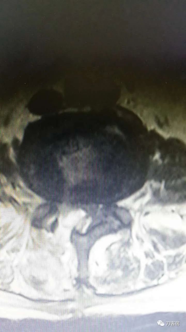 腰椎手术切掉棘突,腰突微创后出血肿
