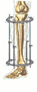 做断骨增高的人怎么样了,做了断骨增高看得出来吗