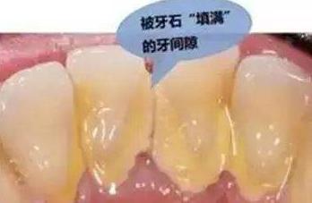 牙缝里面的东西臭臭的怎么解决,牙缝中黄色的污垢臭臭的