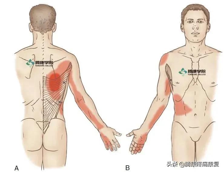 背阔肌综合征病历,背阔综合症