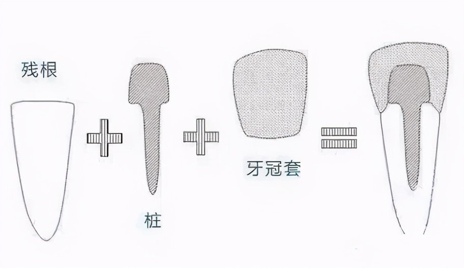 急性牙髓炎诊断错牙齿了怎么办,门牙牙髓坏死根尖炎怎么办