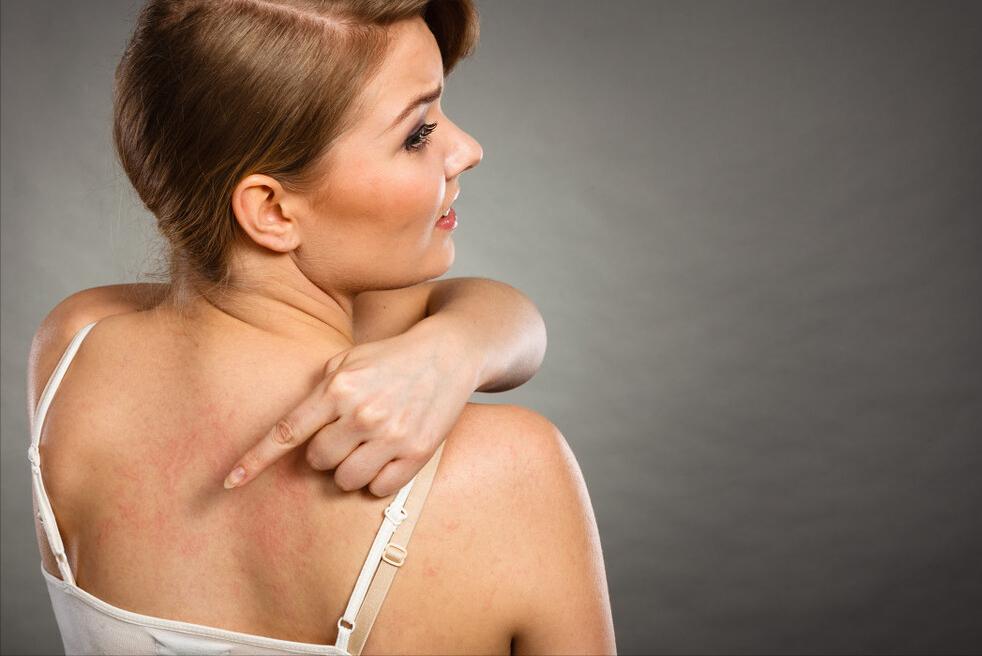 夏季荨麻疹高发期如何应对,麻疹最快的解决方法