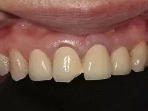 烤瓷牙崩瓷的正确处理方法,烤瓷牙崩瓷了怎么修