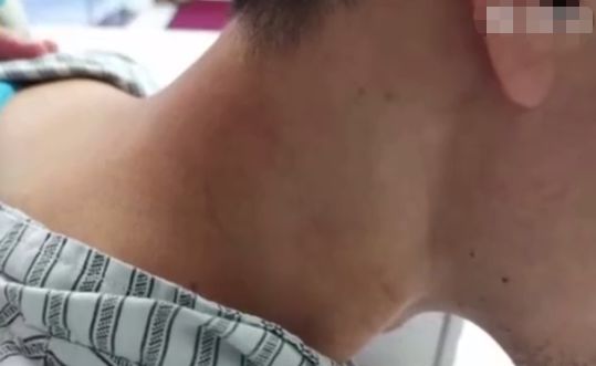 小伙出现头痛等症状，医生：因为做刮痧推拿引发了脑梗