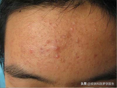 青春痘治疗最佳中成药,青春痘最好的治疗方案