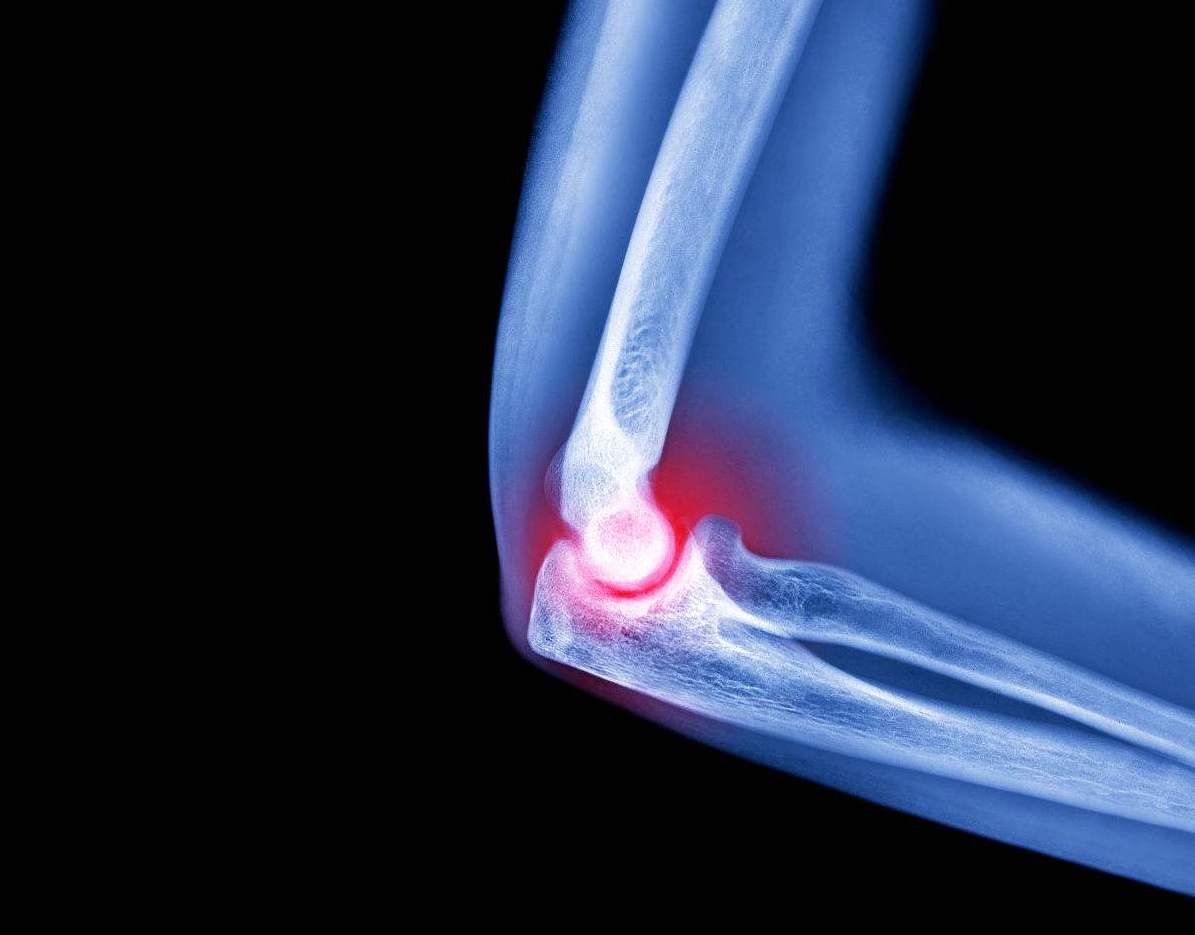 网球肘一定是打网球造成的吗,打网球如何防止网球肘