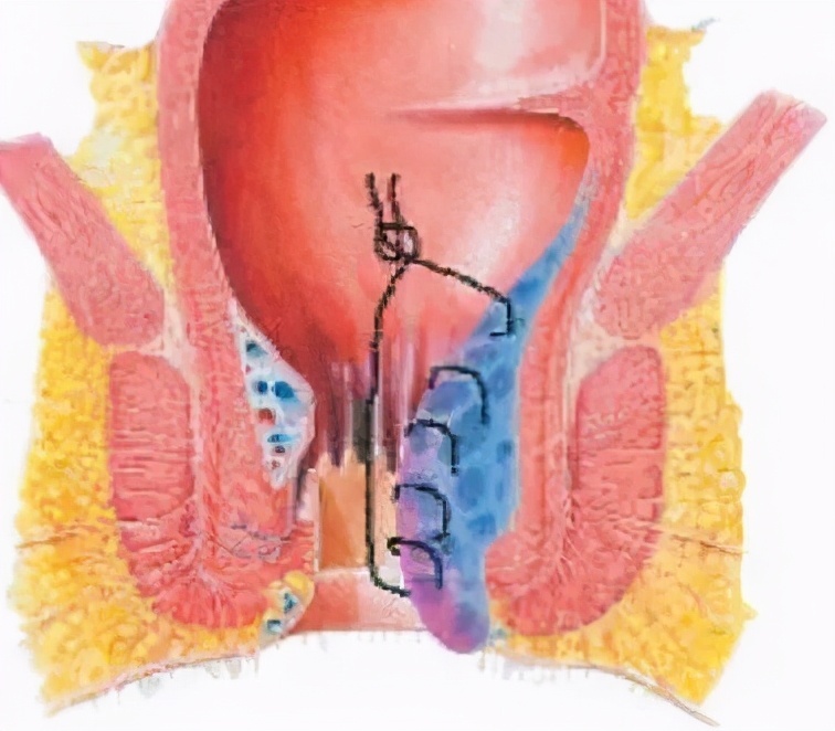 痔疮手术当天去医院就能做吗,两天后能出院的痔疮手术