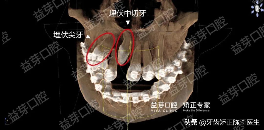埋伏牙用隐形牙套怎么牵引,龅牙隐形牙套矫正全过程