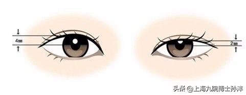 双眼皮为什么会出现眼袋,双眼皮松弛下垂哪种手术比较好