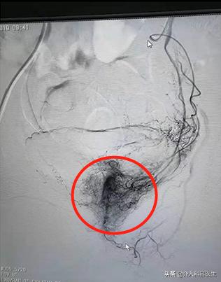 多发子宫肌瘤手术后如何避免复发,多发性子宫肌瘤手术发现内膜增生