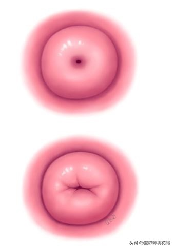 产后妈妈宫颈糜烂,产后妈妈注意盆底肌修复