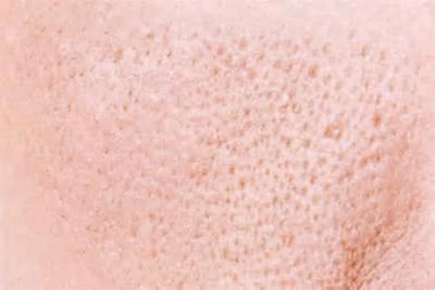 祛痘印痘坑收缩毛孔微针,微针美容是否适合你一份详细指南