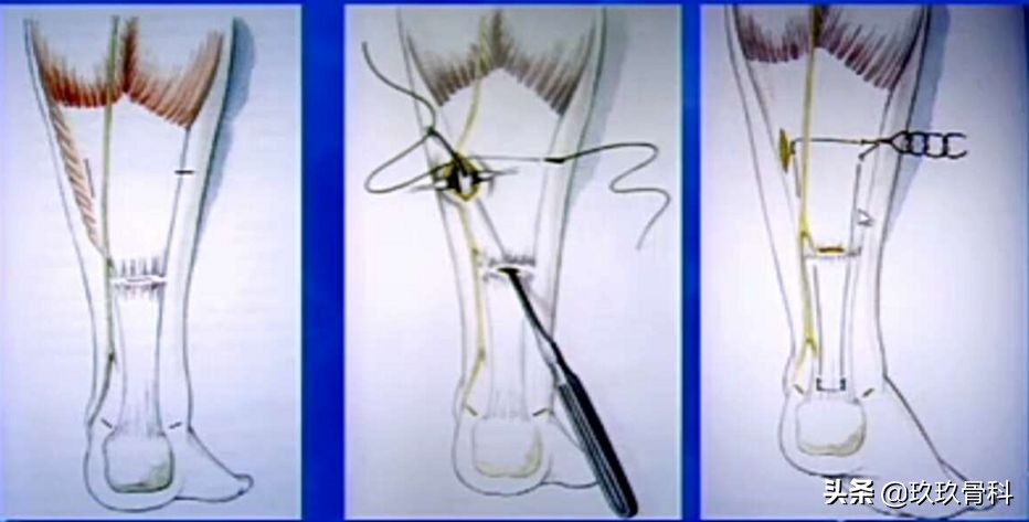 跟腱断裂的确诊方法,超详细跟腱断裂的诊断与治疗