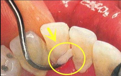 牙齿里很臭的小颗粒,牙齿里黄黄的东西闻起来特别臭