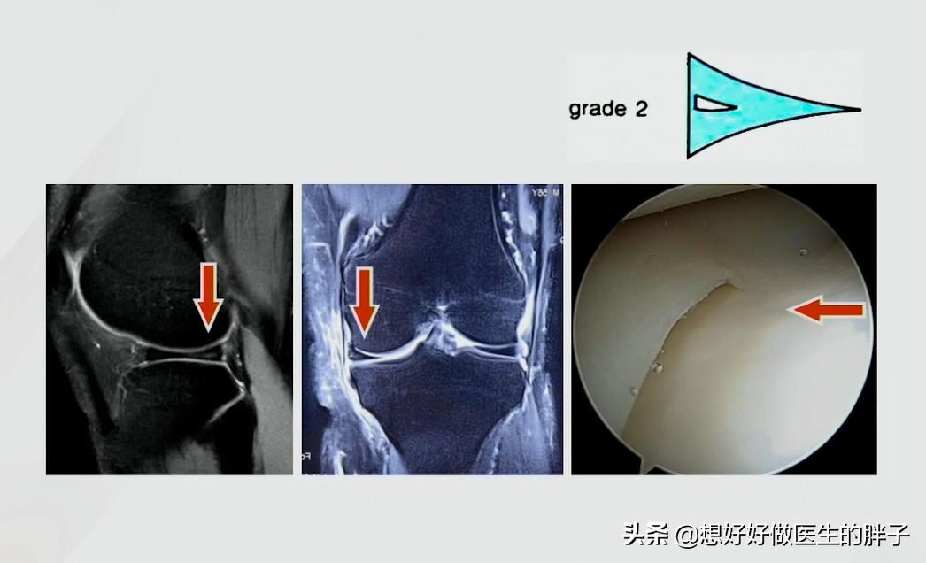 为什么足球运动员不会半月板受伤,半月板伤病对足球运动员影响大吗
