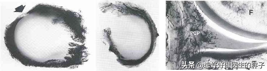 足球运动员为什么没有半月板,足球到底伤半月板吗