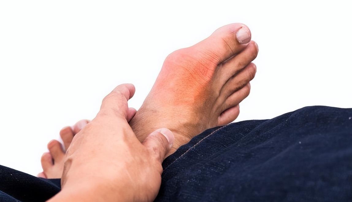 治疗好痛风,治疗痛风怎么才能不伤肝肾