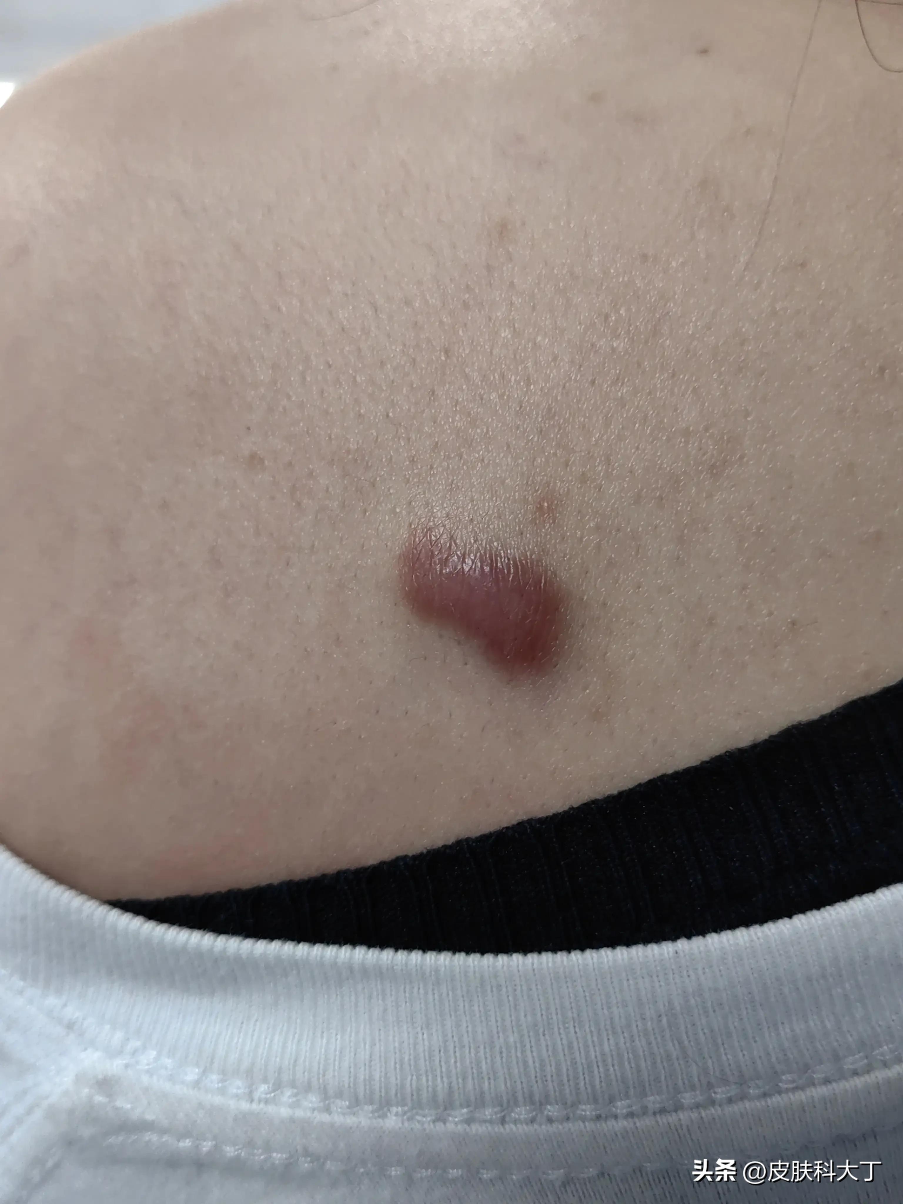 不要随便点痣的图片,不要轻易去痣