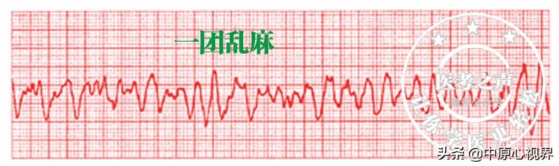 护考几种常见的心电图,常见的心电图图形分析