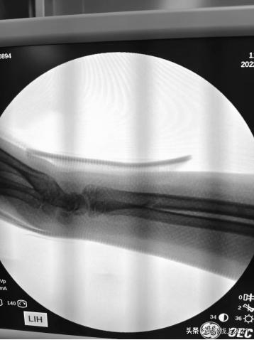 小孩被自行车撞康复要赔偿,孩子不小心被自行车撞了一下