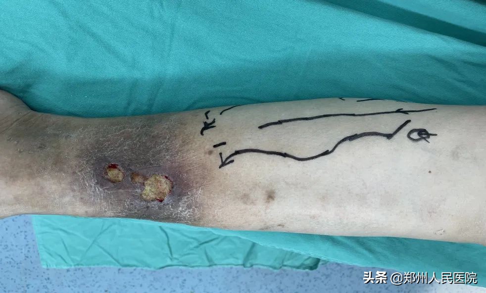 磕碰伤口化脓怎么处理最好的方法,烂腿伤口怎么治疗最好