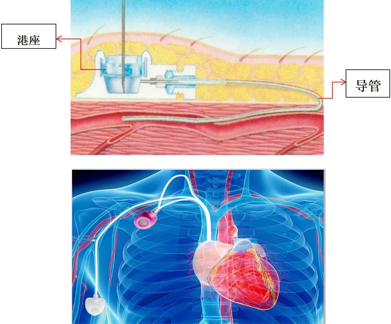 隐形的输液工具——输液港，中长期输液患者的最佳选择