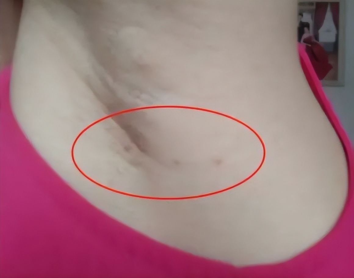 脖子和腋下细细的小肉粒,脖子和面部的小肉粒