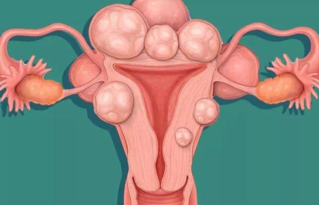 子宫肌瘤可以吃辣菜椒吗,子宫肌瘤可以吃辣肠吗