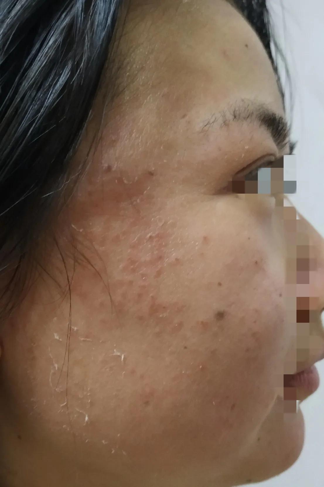 过敏期间护肤的正确方法,过敏期急救护肤用什么