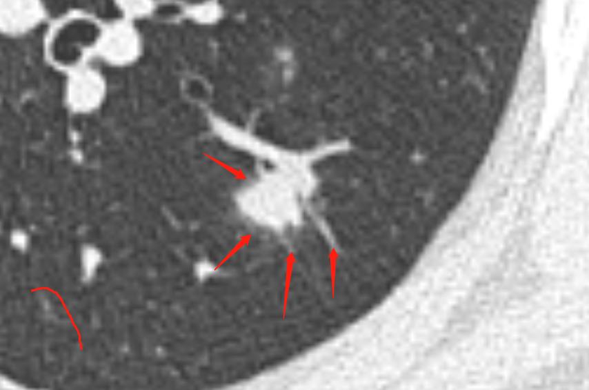 肺结节进一步检查排除肿瘤,肺结节4mm报告建议复查