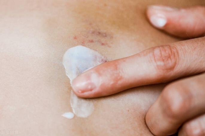 有些人软组织损伤会不会有伤口,人软组织挫伤