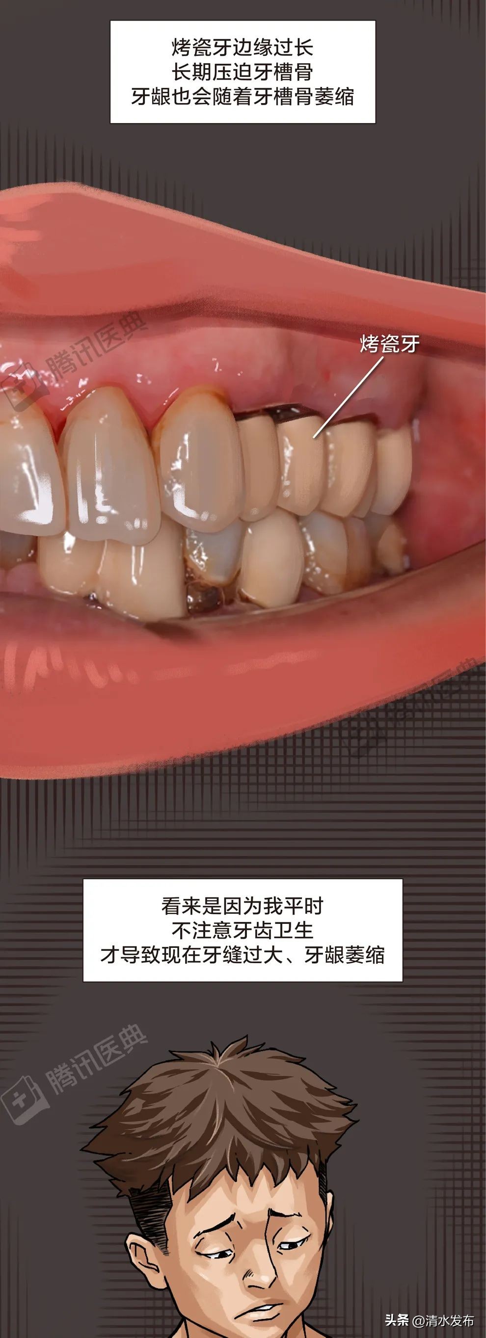 两边大牙一吃肉就塞牙如何修复,14岁学生吃肉老是塞牙需要矫正吗