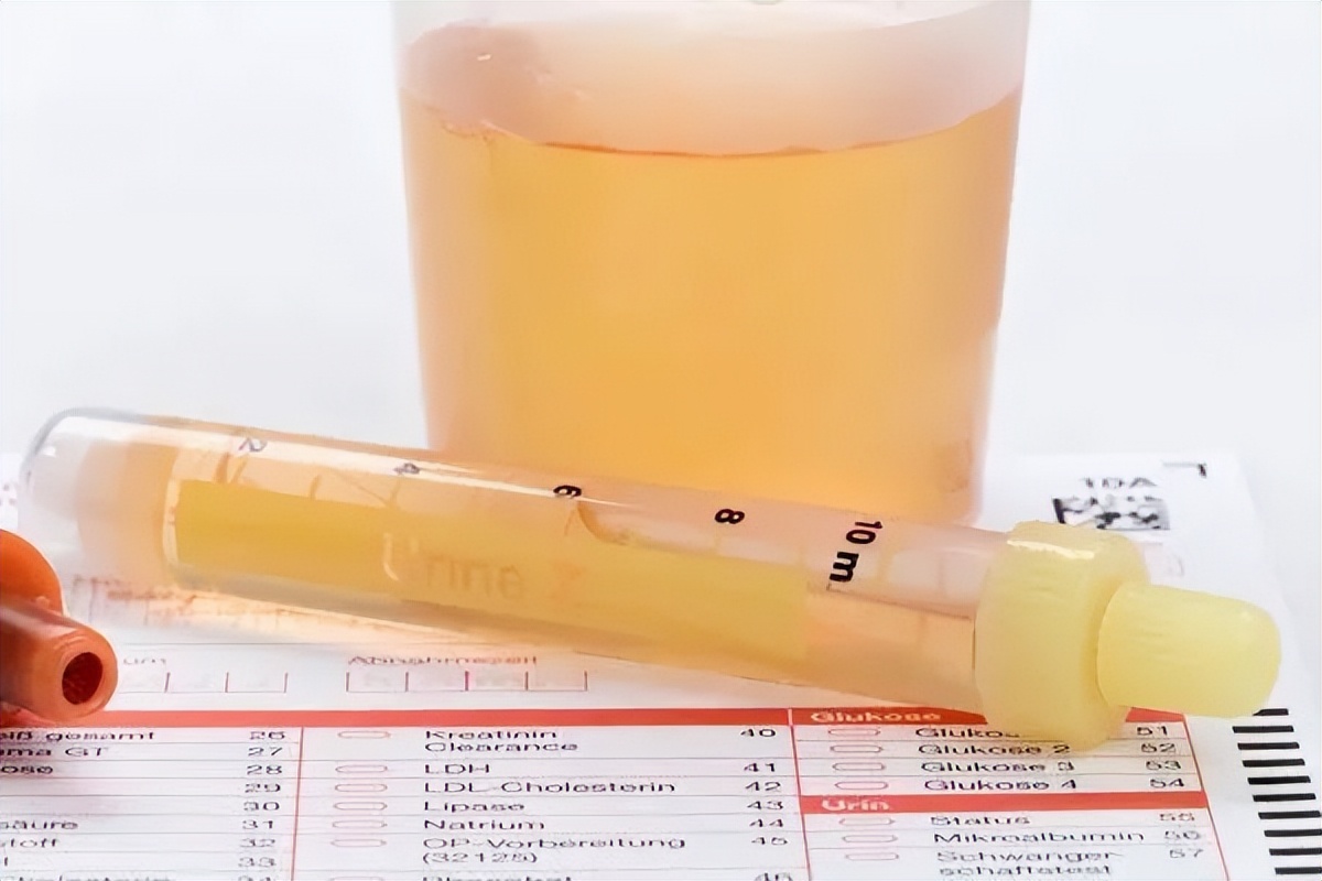 淋病尿常规有哪些异常,尿常规哪些不正常会是肾炎