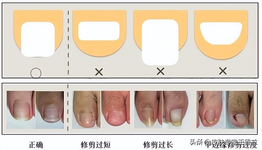 指甲长进肉一碰就疼,指甲长进肉里特别深
