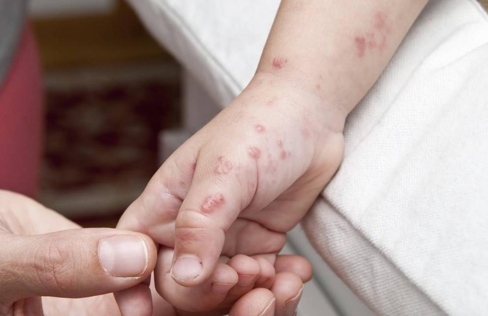 带状性疱疹的疼痛有何方法治疗,头上长带状疱疹怎么才能快速治愈