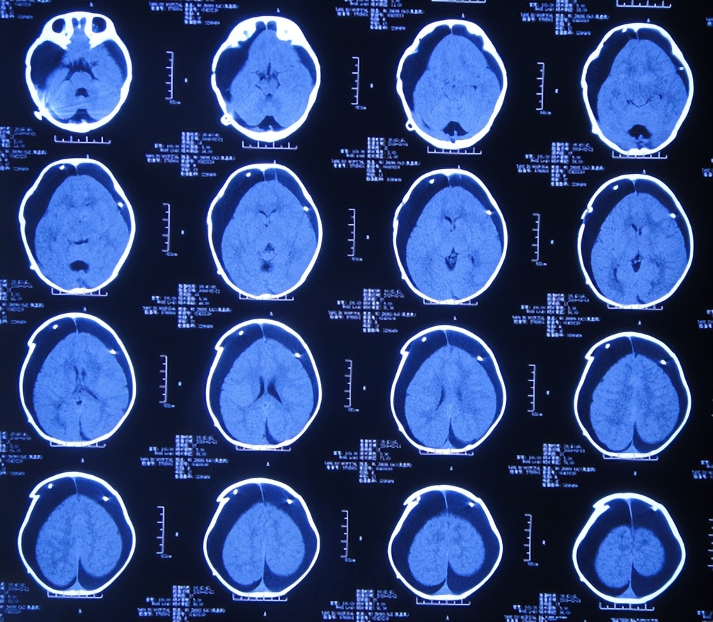 蛛网膜囊肿合并脑积水腹腔分流术,治疗蛛网膜囊肿引起脑积水严重吗