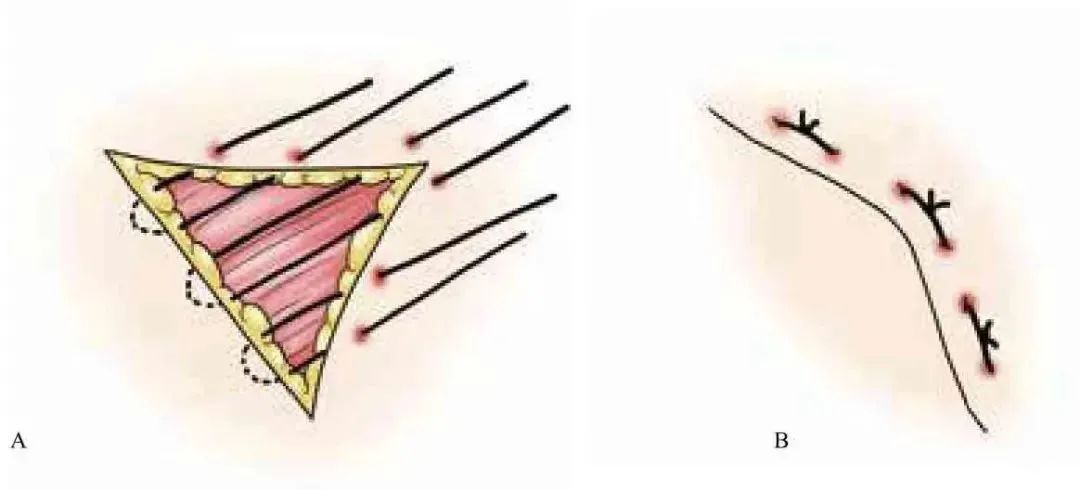 外科顶级缝针技术,外科缝合的操作细节你掌握多少
