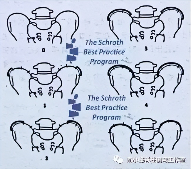 特发性脊柱侧弯40度需要手术吗,青少年特发性脊柱侧弯是什么意思