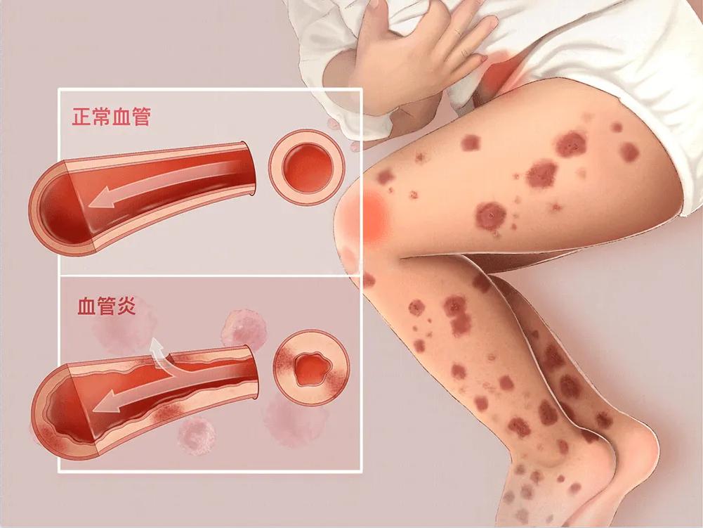 紫癜要怎样治疗才能彻底治愈,紫癜怎么治疗彻底根治最好方法