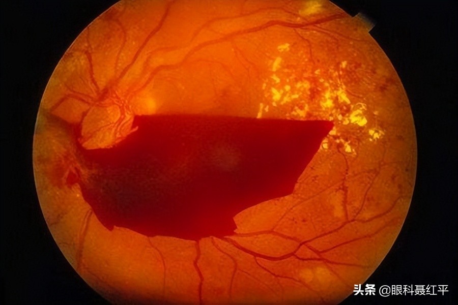 糖尿病眼底出血最快恢复方法,眼底出血的原因和治疗是什么