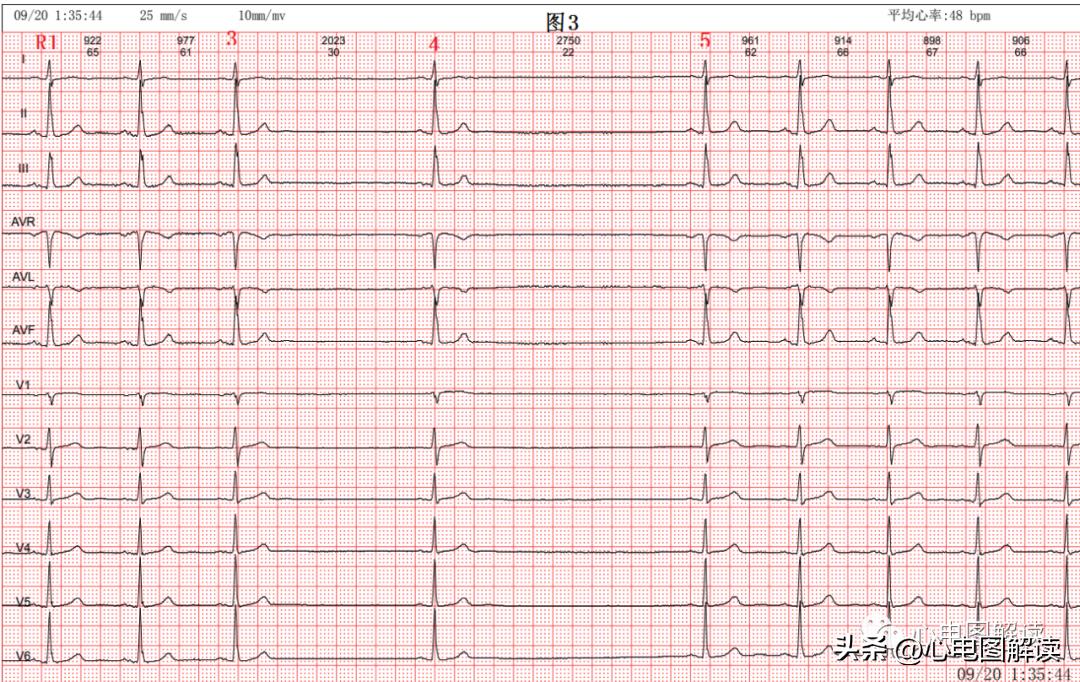 窦性停搏窦房阻滞,窦性停搏窦性静止怎么诊断