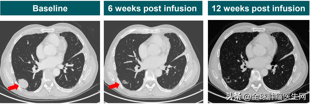 2030年癌症疫苗或将问世是真的吗,癌症疫苗2025年