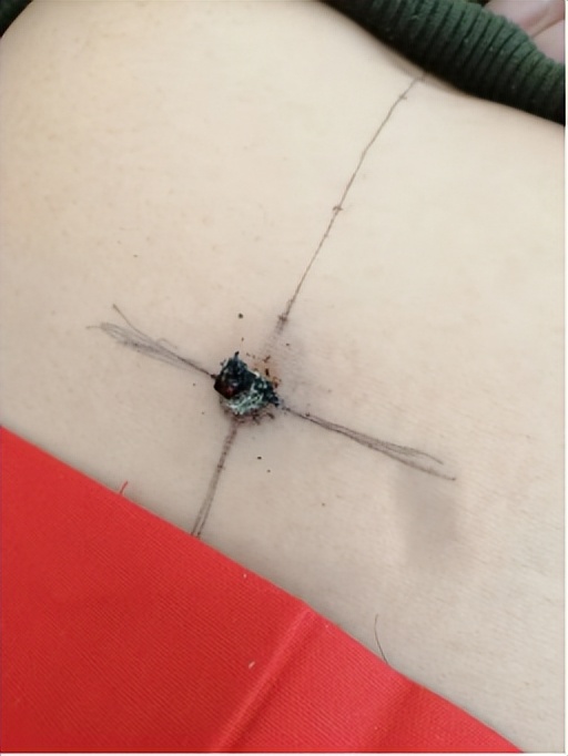 黄贵生灸关元,黄贵生谈灸关元