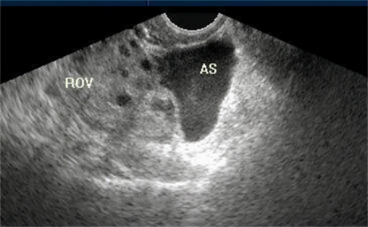 女明星黄体破裂什么原因,绝经的女人黄体会破裂吗