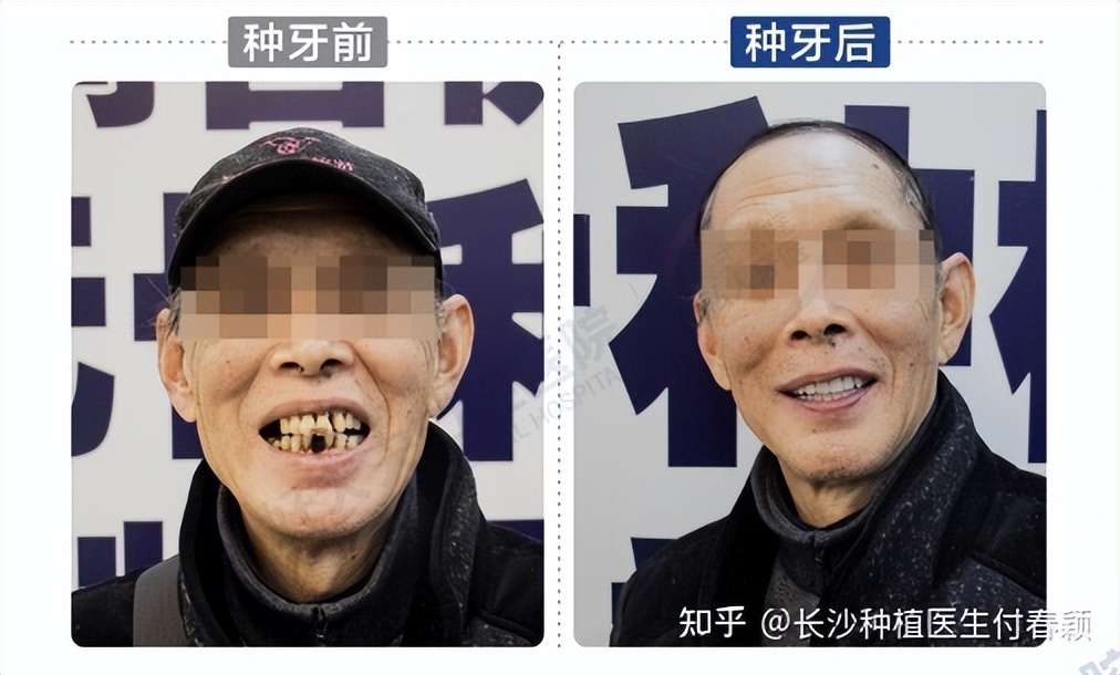 长沙种牙去什么医院种牙最好,长沙种植牙全套价格列表