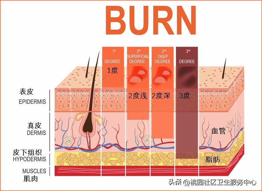 烫伤后抹牙膏怎么洗掉,烫伤涂牙膏酱油有什么作用