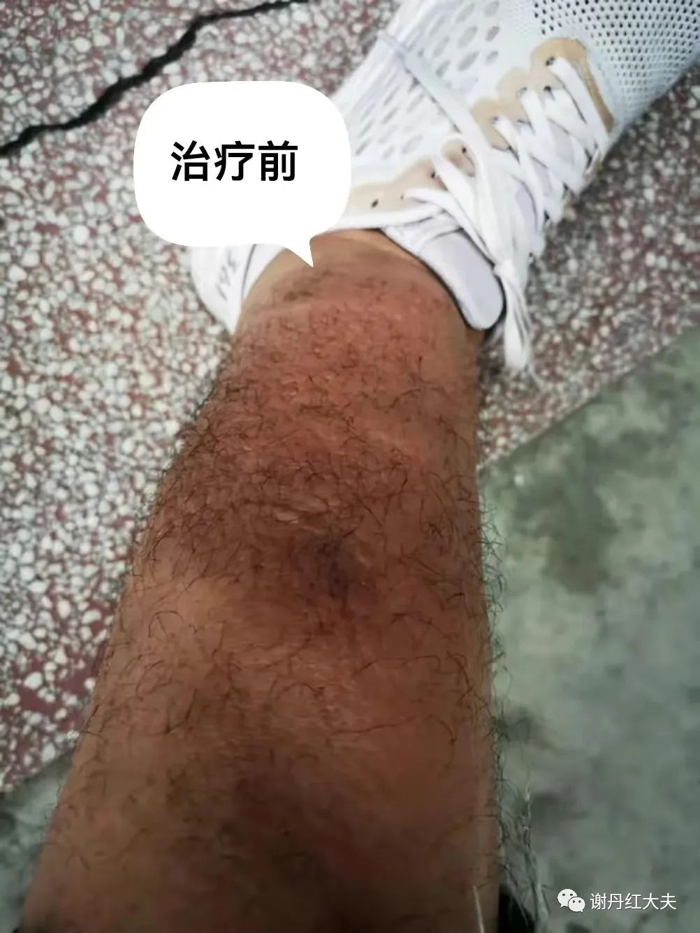 胫前黏液性水肿见于哪些病,胫前黏液性水肿为凹陷性水肿吗