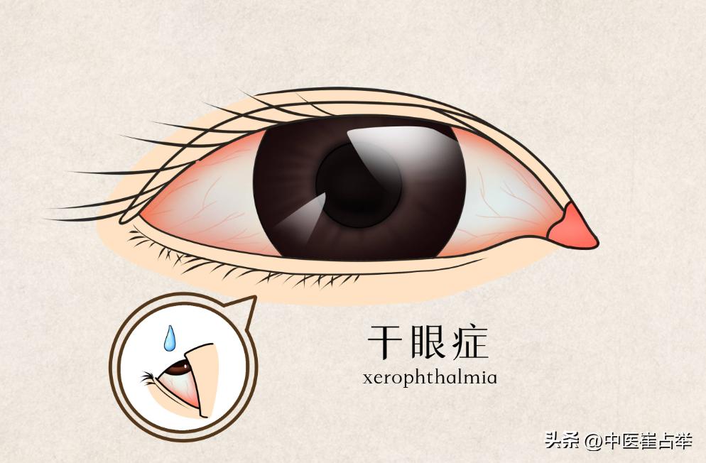 眼科“绝症”？治不好的干眼症，中医只需一招，还你明亮双眼