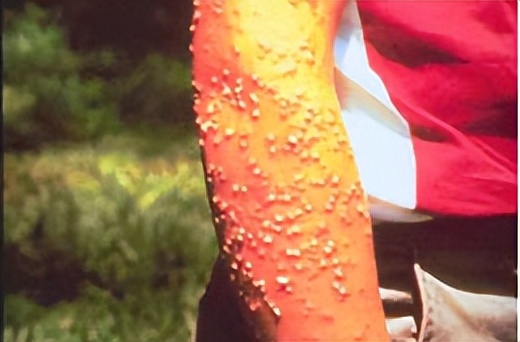 带娃出门游遇到蜱虫千万别乱拔,警惕这三种毒虫带娃出行必看