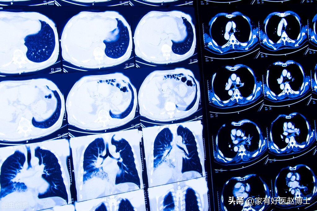 体检提示心血管局部钙化,体检发现冠脉见钙化影是什么意思